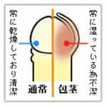 通常陰茎部（サオの部分）を包む包皮が亀頭部にかぶってしまっている状態