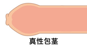 包皮口が非常に狭いため、平常時も勃起時も、包皮をむく事が全く出来ない状態